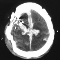 A 65-year-old man experienced a gunshot wound to the right frontoparietal region. A CT scan shows that the bullet crossed the midline, lacerated the superior longitudinal sinus, and produced a large midline subdural hematoma. The patient presented with a Glasgow Coma Scale (GCS) score of 4 and died.