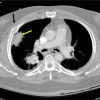 Axial computed tomography image of the chest in a patient with a gunshot wound. Note the comminuted rib fracture (black arrow). A lung contusion is present along the path of the bullet (yellow arrow). A chest tube was placed to treat the right pneumothorax.